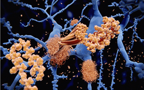 Vắc xin mới điều trị bệnh Alzheimer cho thấy tiềm năng trên chuột